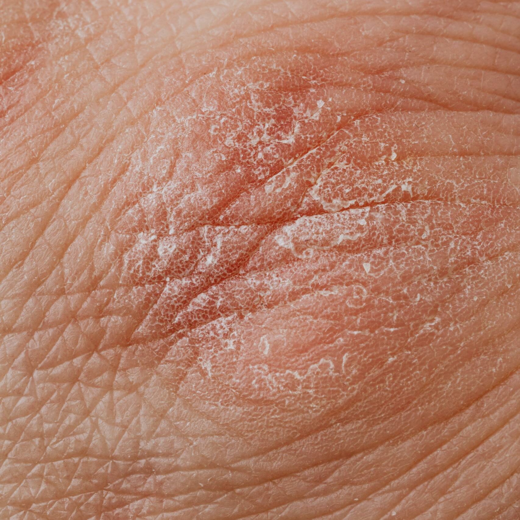 Detailed image highlighting dry, flaky skin texture for dermatological study.